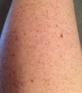 a pale skinned arm with freckles