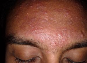 female with lots of Acne on her forehead