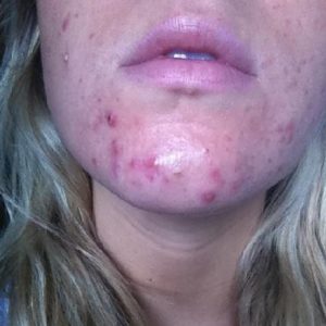 a woman showing Acne scars on her chin